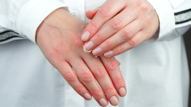 Eczema de contact: cum identifici rapid alergenul declanșator