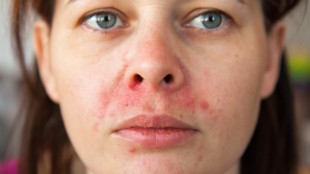 Îngrijirea pielii cu dermatită seboreică: sfaturi pentru ten
