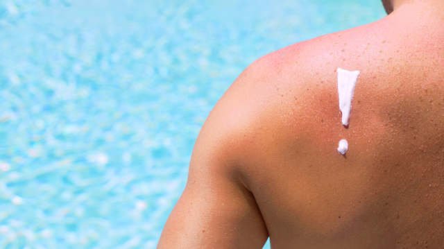 Alergia la soare: simptome, prevenție și ce SPF alegi corect